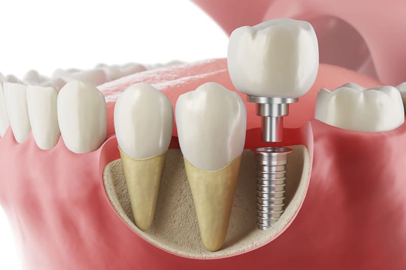 Implantes