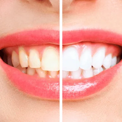 Abordaje integral y soluciones avanzadas para la pérdida dental en CDMX